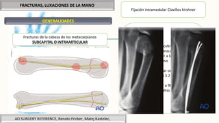 FRACTURAS, LUXACIONES DE LA MANO
GENERALIDADES
AO SURGERY REFERENCE, Renato Fricker, Matej Kastelec,
Fracturas de la cabeza de los metacarpianos
SUBCAPITAL O INTRAARTICULAR
Fijación intramedular Clavillos kirshner
Abordaje dorso cubital o dorsal
La corteza se perfora broca 2.0mmy guía de
broca, perpendicular a la superficie del
hueso
Inclinar 60° y agrandar orificio con broca
2.7 o 3.2
Reducción preliminar a 90° con maniobra
de Jahss
 