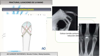 FRACTURAS, LUXACIONES DE LA MANO
GENERALIDADES
Abordaje dorsal para MTC
Reducción con pinzas de campo o kirshner
Colocar tornillo cortical sin desplazar la
reducción obtenida
AO SURGERY REFERENCE, Renato Fricker, Matej Kastelec,
 