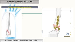 FRACTURAS, LUXACIONES DE LA MANO
FRACTURAS BASE METACARPIANAS
AO SURGERY REFERENCE, Renato Fricker, Matej Kastelec,
 