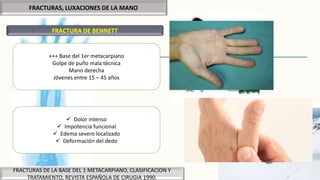 FRACTURAS, LUXACIONES DE LA MANO
FRACTURA DE BENNETT
FRACTURAS DE LA BASE DEL 1 METACARPIANO, CLASIFICACION Y
TRATAMIENTO, REVISTA ESPAÑOLA DE CIRUGIA 1990.
+++ Base del 1er metacarpiano
Golpe de puño mala técnica
Mano derecha
Jóvenes entre 15 – 45 años
 Dolor intenso
 Impotencia funcional
 Edema severo localizado
 Deformación del dedo
 