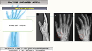 FRACTURAS, LUXACIONES DE LA MANO
FRACTURA DE BENNETT
FRACTURAS DE LA BASE DEL 1 METACARPIANO, CLASIFICACION Y
TRATAMIENTO, REVISTA ESPAÑOLA DE CIRUGIA 1990.
Frente, perfil y oblicuas
 