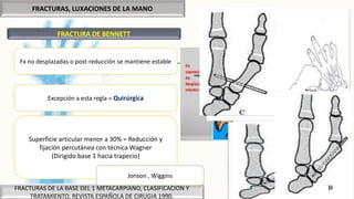 FRACTURAS, LUXACIONES DE LA MANO
FRACTURA DE BENNETT
FRACTURAS DE LA BASE DEL 1 METACARPIANO, CLASIFICACION Y
TRATAMIENTO, REVISTA ESPAÑOLA DE CIRUGIA 1990.
Excepción a esta regla = Quirúrgica
Fx no desplazadas o post-reducción se mantiene estable
Superficie articular menor a 30% = Reducción y
fijación percutánea con técnica Wagner
(Dirigido base 1 hacia trapecio)
Jonson , Wiggins
 