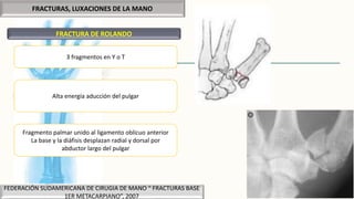 FRACTURAS, LUXACIONES DE LA MANO
FRACTURA DE ROLANDO
3 fragmentos en Y o T
Alta energía aducción del pulgar
Fragmento palmar unido al ligamento oblicuo anterior
La base y la diáfisis desplazan radial y dorsal por
abductor largo del pulgar
FEDERACIÓN SUDAMERICANA DE CIRUGIA DE MANO “ FRACTURAS BASE
1ER METACARPIANO”, 2007
 