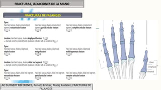FRACTURAS, LUXACIONES DE LA MANO
FRACTURAS DE FALANGES
AO SURGERY REFERENCE, Renato Fricker, Matej Kastelec, FRACTURAS DE
FALANGES
 