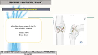 FRACTURAS, LUXACIONES DE LA MANO
FRACTURAS DE FALANGES
AO SURGERY REFERENCE, Renato Fricker, Matej Kastelec, FRACTURAS DE
FALANGES
Abordaje dorsal para articulación
interfalángica proximal
Broca 1.0mm
Broca .8mm
 