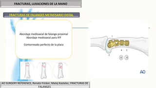 FRACTURAS, LUXACIONES DE LA MANO
FRACTURAS DE FALANGES METAFISARIO DISTAL
AO SURGERY REFERENCE, Renato Fricker, Matej Kastelec, FRACTURAS DE
FALANGES
Abordaje medioaxial de falange proximal
Abordaje medioaxial para IFP
Contorneado perfecto de la placa
 
