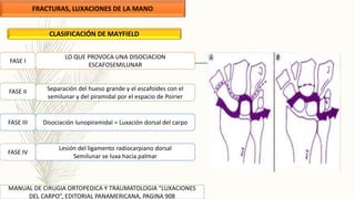 FRACTURAS, LUXACIONES DE LA MANO
MANUAL DE CIRUGIA ORTOPEDICA Y TRAUMATOLOGIA “LUXACIONES
DEL CARPO”, EDITORIAL PANAMERICANA, PAGINA 908
CLASIFICACIÓN DE MAYFIELD
PURA
 Lesión del ligamento interóseo escafosemilunar
 Radio- escafo- hueso grande palmar
FASE I
LO QUE PROVOCA UNA DISOCIACION
ESCAFOSEMILUNAR
Separación del hueso grande y el escafoides con el
semilunar y del piramidal por el espacio de Poirier
FASE II
FASE III Disociación lunopiramidal = Luxación dorsal del carpo
FASE IV
Lesión del ligamento radiocarpiano dorsal
Semilunar se luxa hacia palmar
 