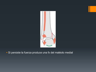  Si persiste la fuerza produce una fx del maléolo medial
 