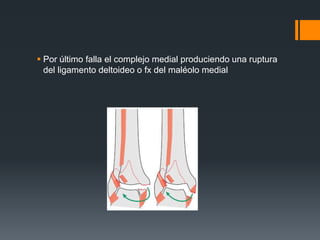  Por último falla el complejo medial produciendo una ruptura
del ligamento deltoideo o fx del maléolo medial
 