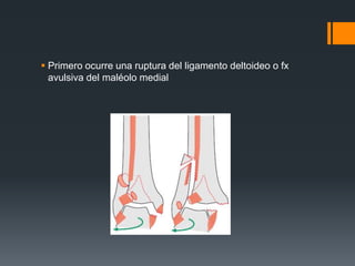  Primero ocurre una ruptura del ligamento deltoideo o fx
avulsiva del maléolo medial
 
