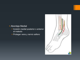  Abordaje Medial
 Incisión medial posterior o anterior
al maleolo
 Proteger vena y nervio safeno
 