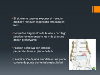  El siguiente paso es exponer el maleolo
medial y remover el periostio atrapado en
la fx
 Pequeños fragmentos de hueso y cartílago
pueden removerse pero los más grandes
deben preservarse
 Fijación definitiva con tornillos
perpendiculares al plano de la fx
 La aplicación de una arandela o una placa
corta en la punta aumenta la estabilidad
 