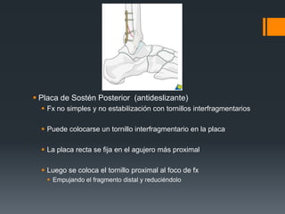  Placa de Sostén Posterior (antideslizante)
 Fx no simples y no estabilización con tornillos interfragmentarios
 Puede colocarse un tornillo interfragmentario en la placa
 La placa recta se fija en el agujero más proximal
 Luego se coloca el tornillo proximal al foco de fx
 Empujando el fragmento distal y reduciéndolo
 
