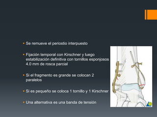  Se remueve el periostio interpuesto
 Fijación temporal con Kirschner y luego
estabilización definitiva con tornillos esponjosos
4.0 mm de rosca parcial
 Si el fragmento es grande se colocan 2
paralelos
 Si es pequeño se coloca 1 tornillo y 1 Kirschner
 Una alternativa es una banda de tensión
 