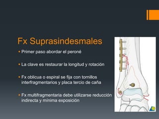 Fx Suprasindesmales
 Primer paso abordar el peroné
 La clave es restaurar la longitud y rotación
 Fx oblicua o espiral se fija con tornillos
interfragmentarios y placa tercio de caña
 Fx multifragmentaria debe utilizarse reducción
indirecta y mínima exposición
 