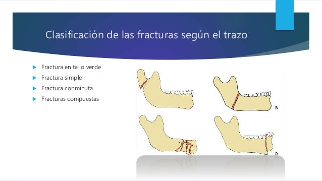 Fracturas mandibulares