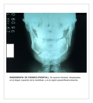 RADIOGRAFIA DE CRANEO (FRONTAL). Se aprecia fracturas desplazadas
en el ángulo izquierdo de la mandíbula y en la región parasinfisiaria derecha.
 