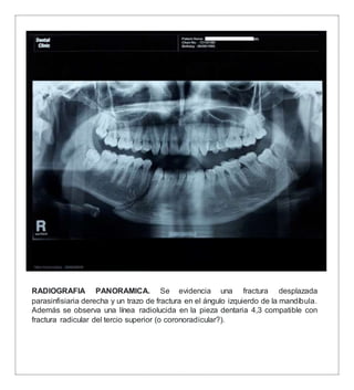 RADIOGRAFIA PANORAMICA. Se evidencia una fractura desplazada
parasinfisiaria derecha y un trazo de fractura en el ángulo izquierdo de la mandíbula.
Además se observa una línea radiolucida en la pieza dentaria 4,3 compatible con
fractura radicular del tercio superior (o coronoradicular?).
 