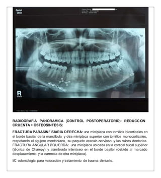 RADIOGRAFIA PANORAMICA (CONTROL POSTOPERATORIO): REDUCCION
CRUENTA + OSTEOSINTESIS:
FRACTURA PARASINFISIARIA DERECHA: una miniplaca con tornillos bicorticales en
el borde basilar de la mandíbula y otra miniplaca superior con tornillos monocorticales,
respetando el agujero mentoniano, su paquete vasculo-nervioso y las raíces dentarias.
FRACTURA ANGULAR IZQUIERDA: una miniplaca ubicada en la cortical bucal superior
(técnica de Champy) y alambrado interóseo en el borde basilar (debido al marcado
desplazamiento y la carencia de otra miniplaca).
I/C odontología para valoración y tratamiento de trauma dentario.
 