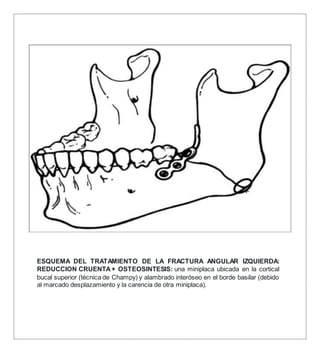 ESQUEMA DEL TRATAMIENTO DE LA FRACTURA ANGULAR IZQUIERDA:
REDUCCION CRUENTA+ OSTEOSINTESIS: una miniplaca ubicada en la cortical
bucal superior (técnica de Champy) y alambrado interóseo en el borde basilar (debido
al marcado desplazamiento y la carencia de otra miniplaca).
 