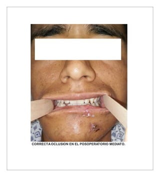 CORRECTAOCLUSION EN EL POSOPERATORIO MEDIATO.
 