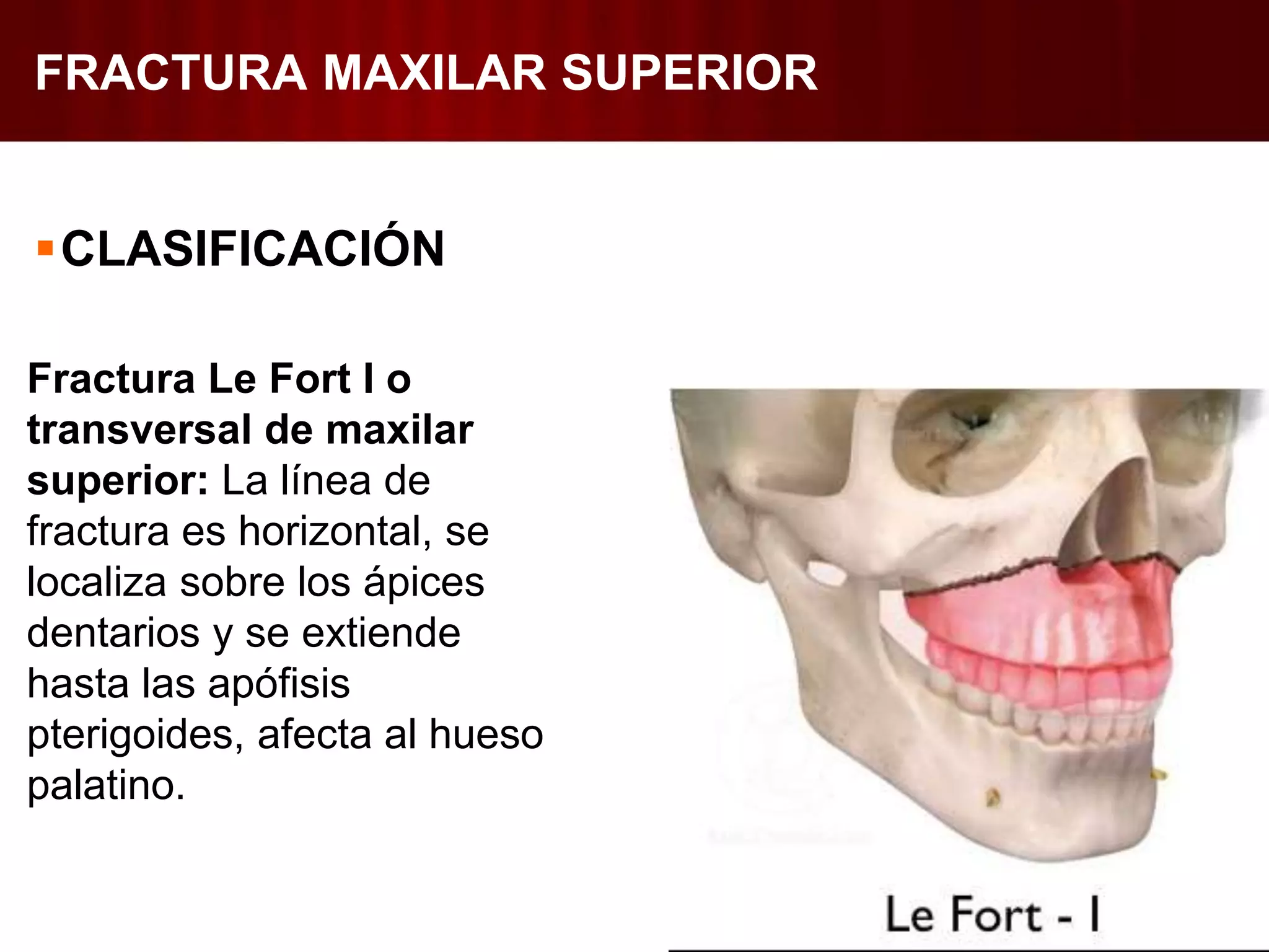 Fracturas Maxilar Superior | PPTX