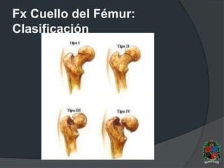 Fx Cuello del Fémur:
Clasificación
 