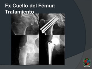 Fx Cuello del Fémur:
Tratamiento
 
