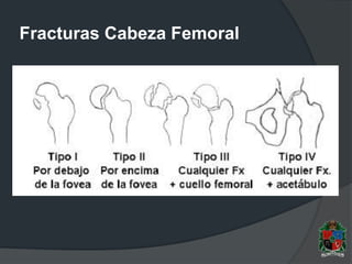 Fracturas Cabeza Femoral
 