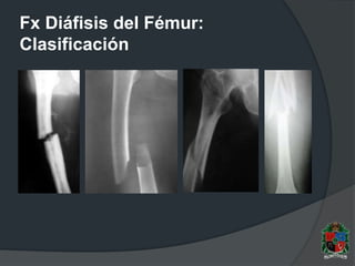 Fx Diáfisis del Fémur:
Clasificación
 