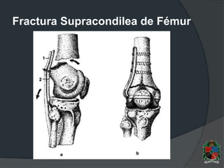 Fractura Supracondilea de Fémur
 