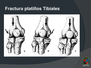 Fractura platillos Tibiales
 