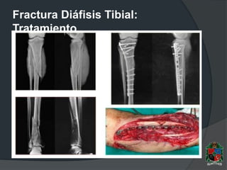Fractura Diáfisis Tibial:
Tratamiento
 