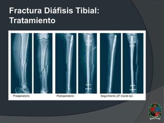 Fractura Diáfisis Tibial:
Tratamiento
 