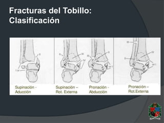 Fracturas del Tobillo:
Clasificación
 