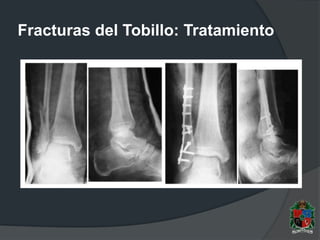 Fracturas del Tobillo: Tratamiento
 