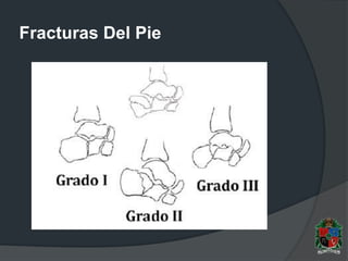 Fracturas Del Pie
 