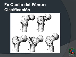 Fx Cuello del Fémur:
Clasificación
 
