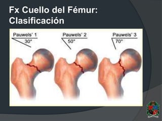 Fx Cuello del Fémur:
Clasificación
 