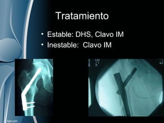 Tratamiento
• Estable: DHS, Clavo IM
• Inestable: Clavo IM
 