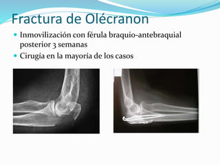 fracturas-de-miembros-superiores-m-s-frecuentes-pptx