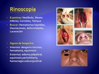  Examinar:Vestíbulo, Meato
Inferior, Cornetes,Tabique
 Buscar: Hematomas Septáles,
Desviaciones, deformidades,
Laceración
 Signos de Sospecha:
 Internos: desgarro mucoso,
hematoma, equimosis
 Externos: edema palpebral,
equimosis periorbitaria,
hemorragia subconjuntival
 