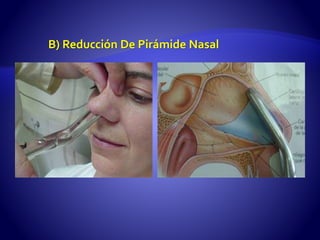 B) Reducción De Pirámide Nasal
 