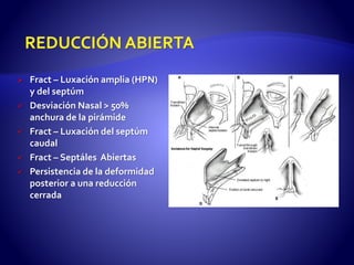  Fract – Luxación amplia (HPN)
y del septúm
 Desviación Nasal > 50%
anchura de la pirámide
 Fract – Luxación del septúm
caudal
 Fract – Septáles Abiertas
 Persistencia de la deformidad
posterior a una reducción
cerrada
 