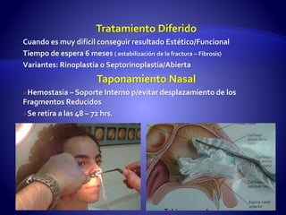 Tratamiento Diferido
Cuando es muy difícil conseguir resultado Estético/Funcional
Tiempo de espera 6 meses ( estabilización de la fractura – Fibrosis)
Variantes: Rinoplastia o Septorinoplastia/Abierta
Taponamiento Nasal
Hemostasia – Soporte Interno p/evitar desplazamiento de los
Fragmentos Reducidos
Se retira a las 48 – 72 hrs.
 