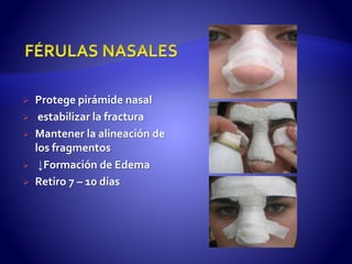  Protege pirámide nasal
 estabilizar la fractura
 Mantener la alineación de
los fragmentos
 ↓Formación de Edema
 Retiro 7 – 10 días
 