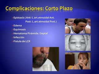 Epistaxis ( Ant: L.art.etmoidal Ant.
Post: L.art.etmoidal Post.)
Edema
Equimosis
Hematoma Pirámide / Septal
Infección
Fistula de LCR
 