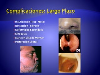 Insuficiencia Resp. Nasal
Retracción , Fibrosis
Deformidad Secundaria
Sinéquias
Nariz en Silla de Montar
Perforación Septal
 