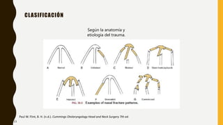 CLASIFICACIÓN
Según la anatomía y
etiología del trauma.
Paul W. Flint, B. H. (n.d.). Cummings Otolaryngology Head and Neck Surgery 7th ed.
13
 