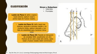 CLASIFICACIÓN Stranc y Robertson
• Laterales
• Frontales
• Lesión de Plano I: daño a espina
nasal anterior, septum nasal o
partes bajas de huesos nasales.
• Lesión de Plano II: daño nasal mas
extenso, asciende a proceso maxilar y no
involucra órbita, septum desviado y con
falta de estabilidad para mantener dorso
nasal.
• Lesión de Plano III: Resulta en disrupción
de complejo NOE, usualmente con otra
fractura de en cara y base del craneo, septo
nasal y huesos nasales están conminutos.
Paul W. Flint, B. H. (n.d.). Cummings Otolaryngology Head and Neck Surgery 7th ed.
14
 